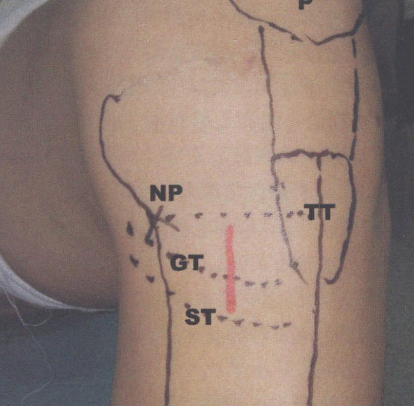 第二节  采用腘绳肌肌腱重建前交叉韧带